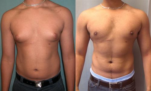 Experiencias reales de usuarios: Qu&eacute; dicen los hombres sobre Gynectrol